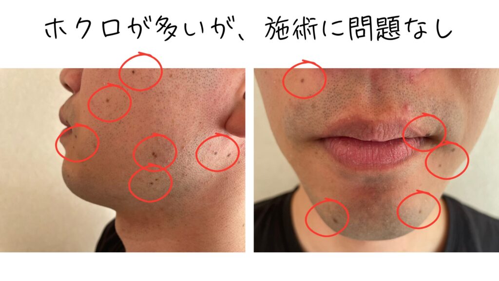 ホクロが多くても施術に問題がなかったことを示した写真