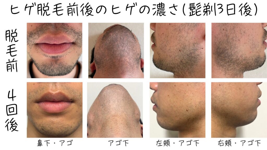 Comparison of effects before and after beard hair removal