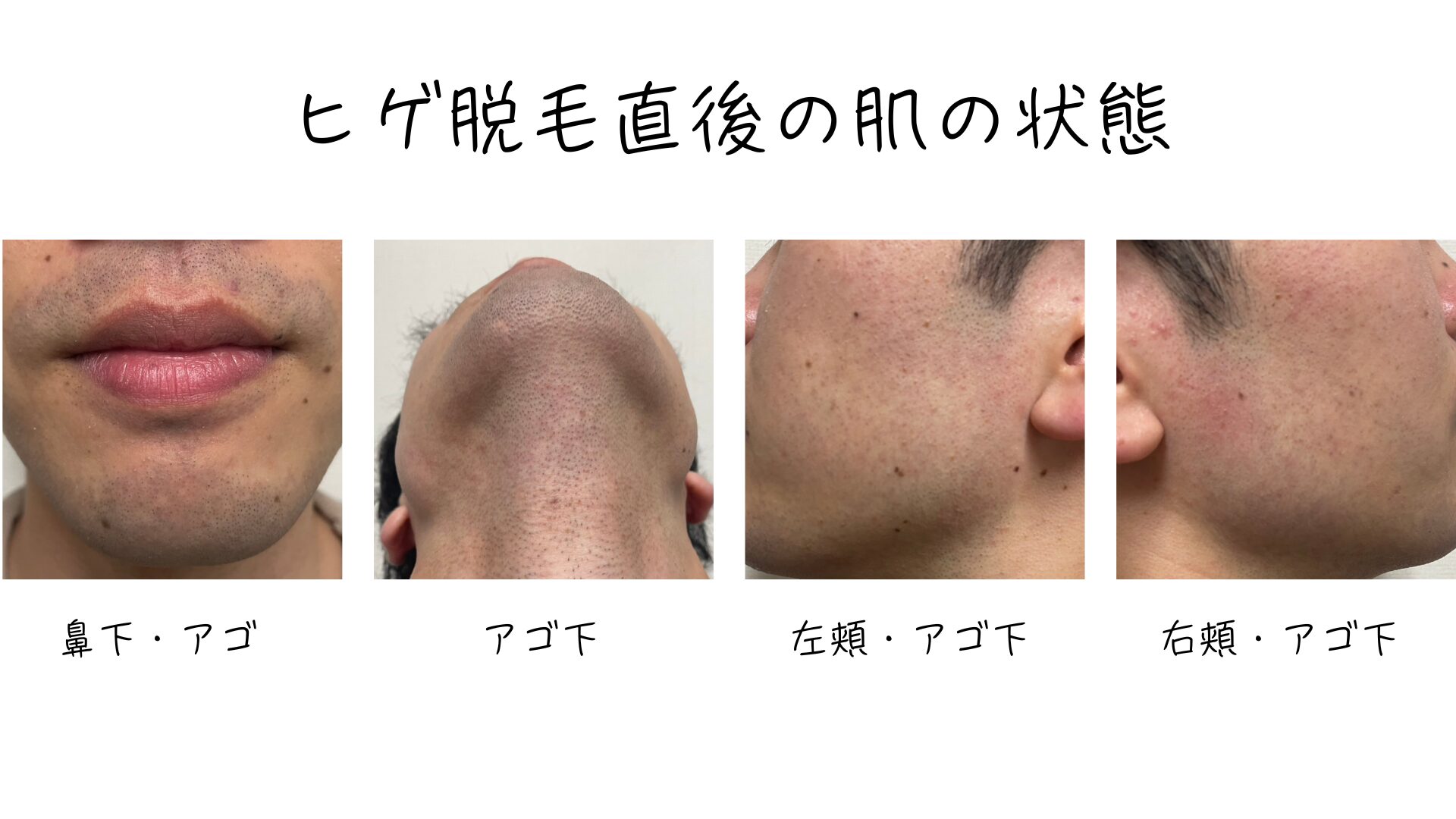 ヒゲ脱毛のあとの肌の様子