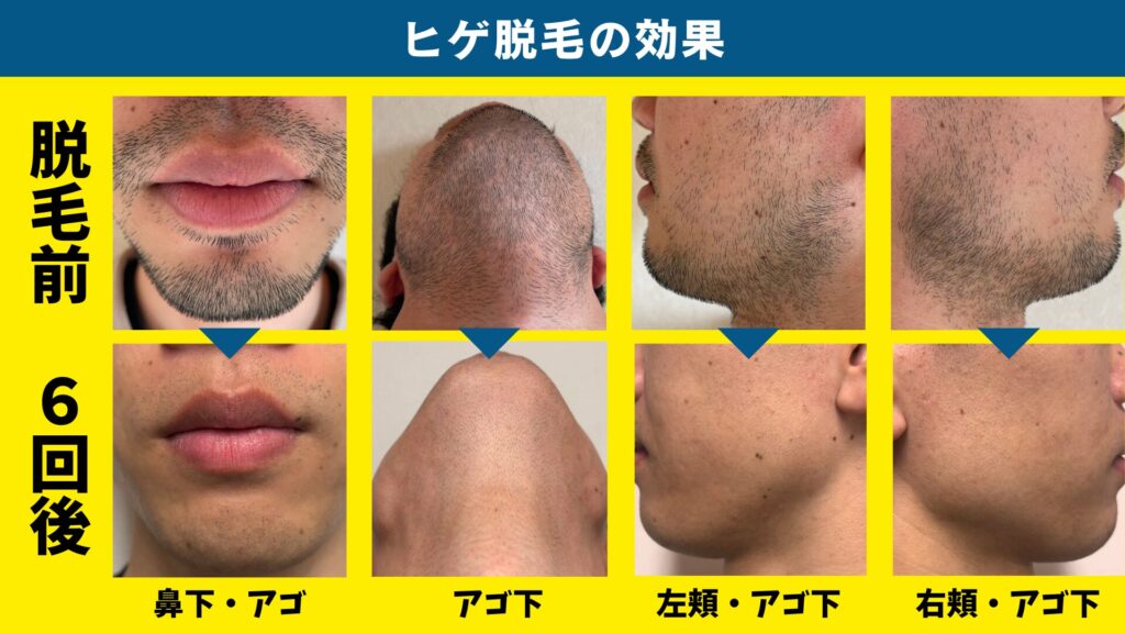 The effect of 6 sessions of beard hair removal