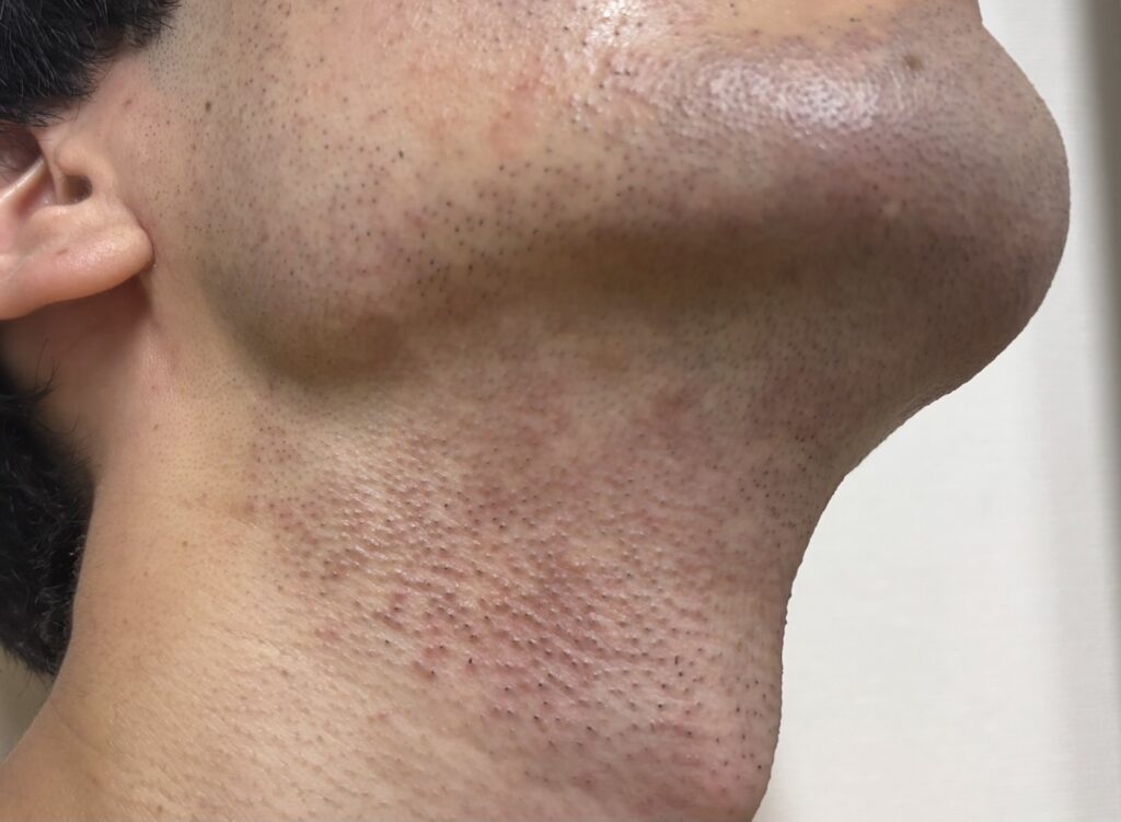 Skin irritation immediately after beard removal