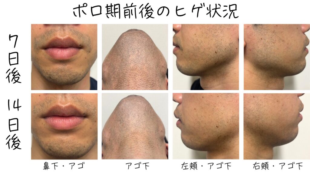 The condition of the beard before and after the hair removal period
