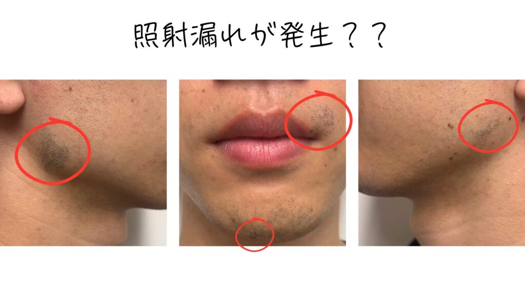 Shonan Beauty Clinic beard hair removal irradiation leak image
