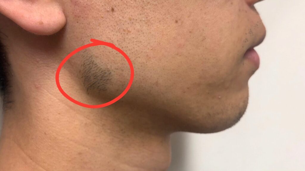 Image of missed hair removal treatment