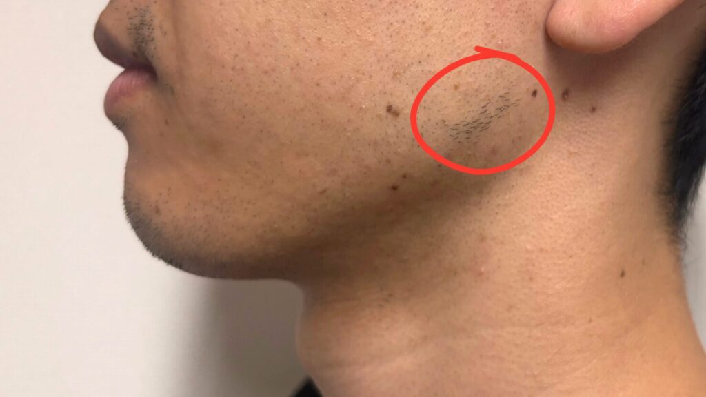 Image of missed hair removal treatment