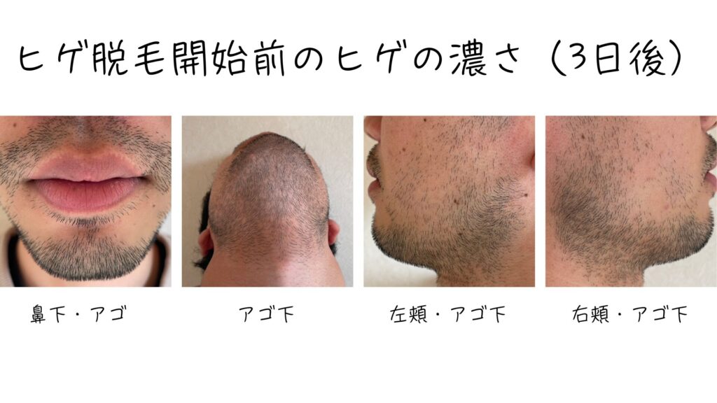 The condition of the beard before hair removal