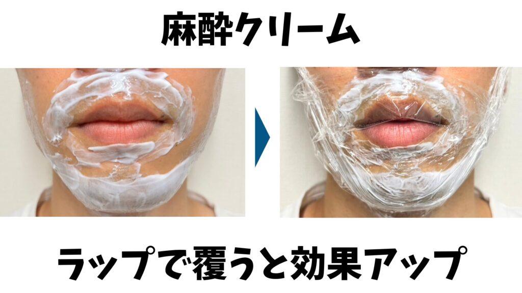 ヒゲ脱毛】麻酔クリームの効果をぶっちゃけレビュー！痛みを60％消せる