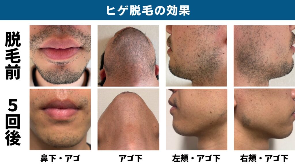 Before and after five sessions of beard hair removal