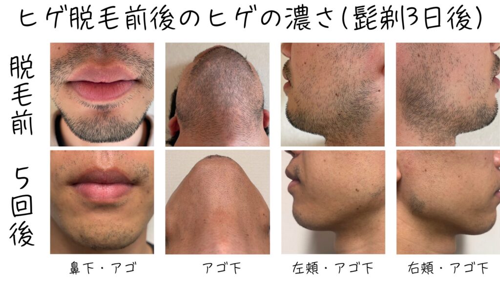 The effects of five beard hair removal treatments on six areas at Shonan Beauty Clinic