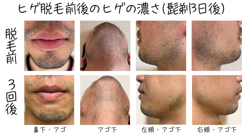 The effect of 3 beard hair removal sessions