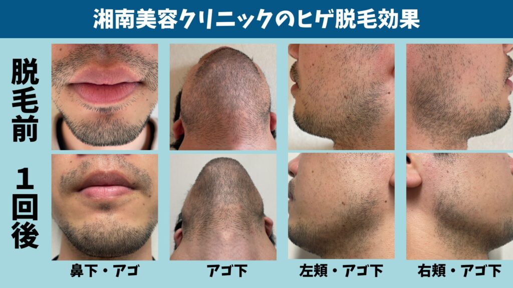The effect of the first beard hair removal session at Shonan Beauty Clinic
