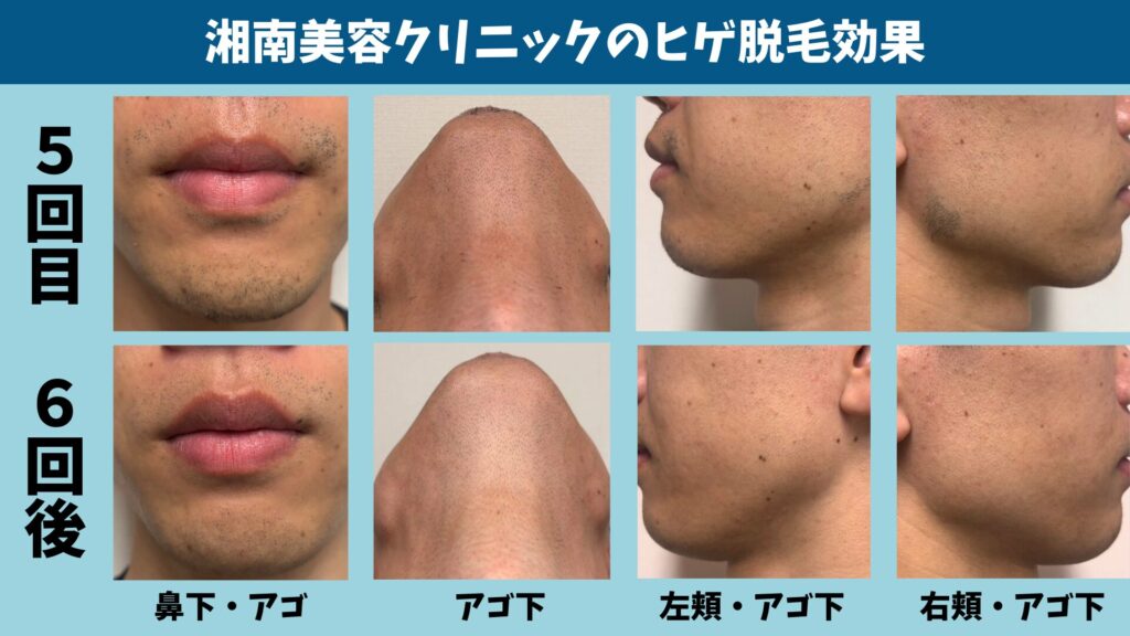 The effect of the 6th session of beard hair removal at Shonan Beauty Clinic