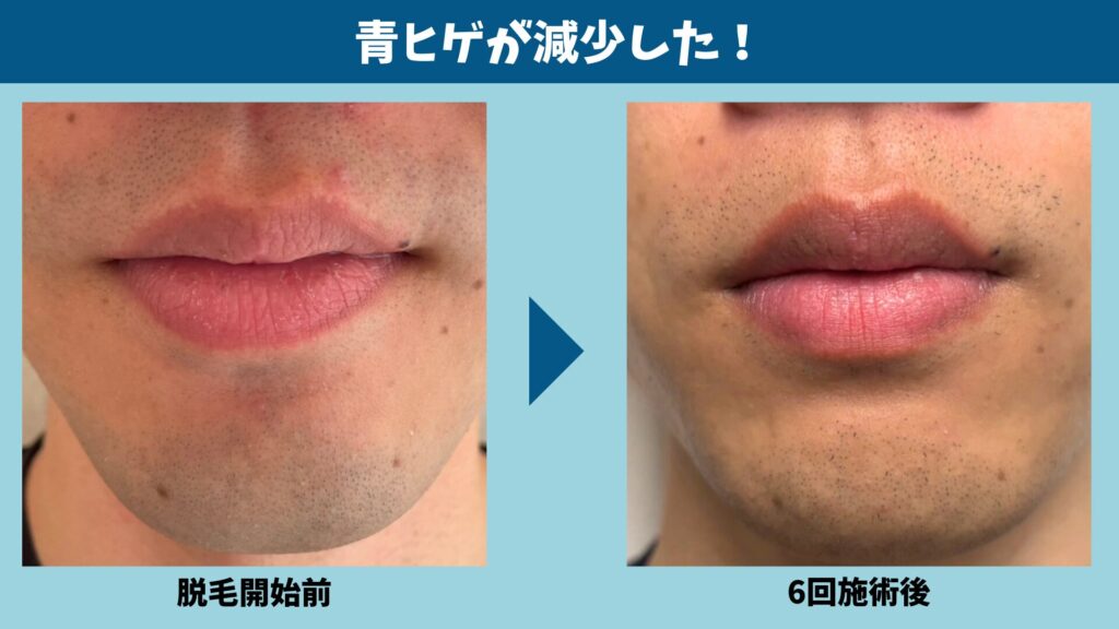 Six treatments at Shonan Beauty Clinic reduced my gray beard