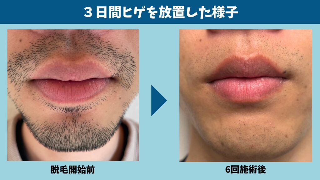 Before hair removal and after 6 sessions, leaving the beard unshaved for 3 days