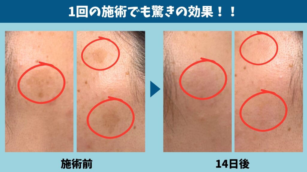 1回の施術で施術前と14日後のシミがどう変わったかを並べた比較写真