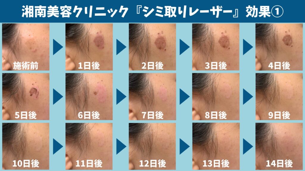 Effect of laser for removing spots①