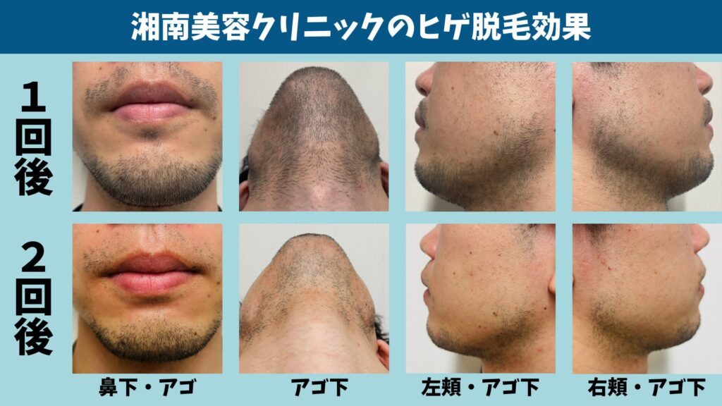 The effect of the second beard hair removal treatment at Shonan Beauty Clinic