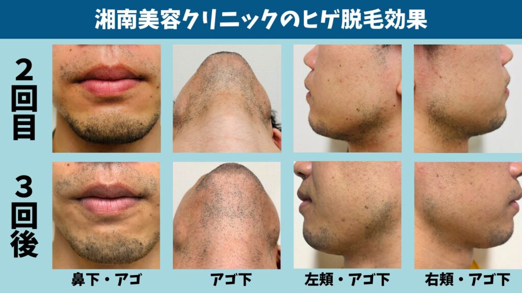 The effect of the third beard hair removal session at Shonan Beauty Clinic