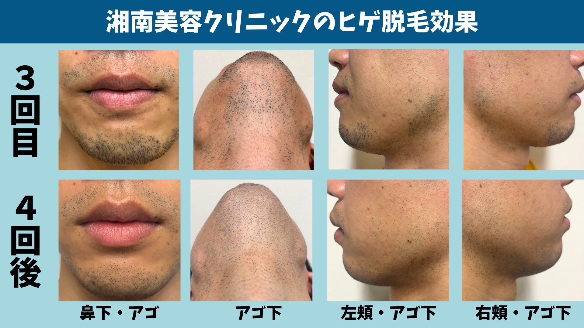 湘南美容クリニックのヒゲ脱毛3回目と4回後のヒゲの比較写真