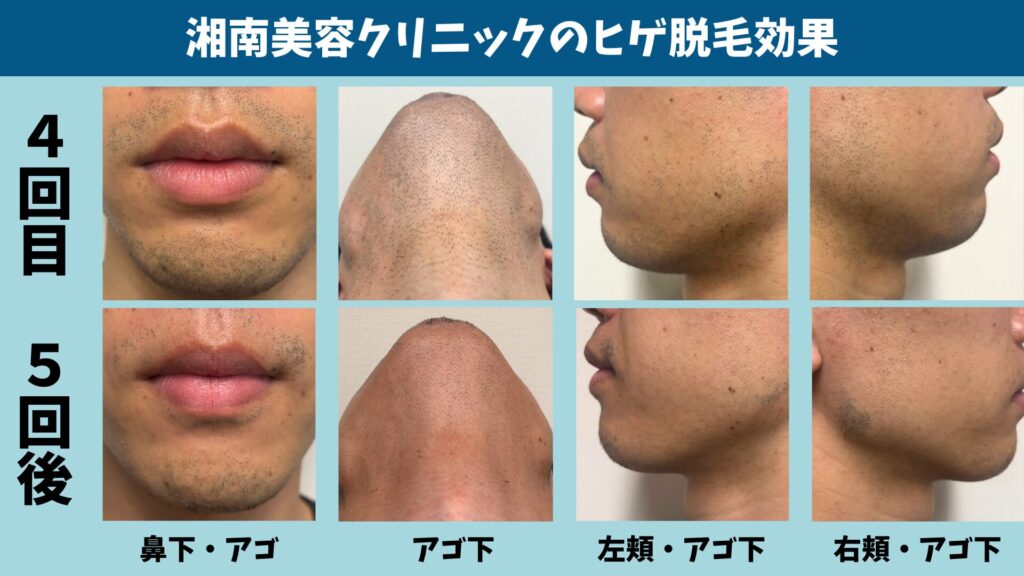 The effect of the 5th beard hair removal session at Shonan Beauty Clinic