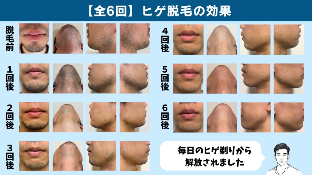 Effects of 6 sessions of beard hair removal at Shonan Beauty Clinic (effects by session)