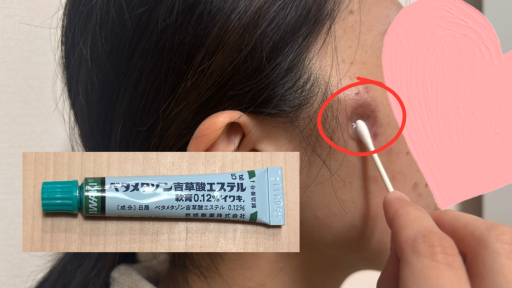 シミ取りレーザー後に処方された軟膏を塗る様子を示した図解