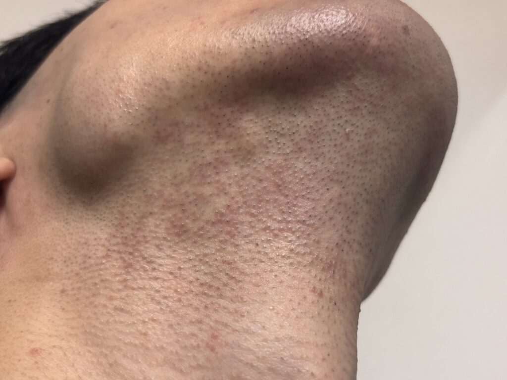 Risk of skin irritation and redness