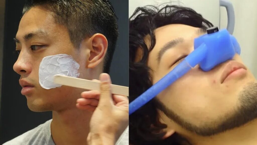 Anesthetic cream and nitrous oxide anesthesia