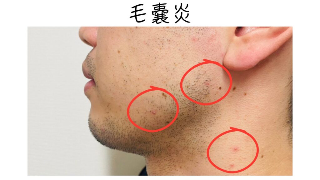 Folliculitis appearance