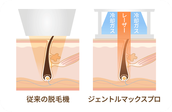 Regina Clinic Gentle Max Pro Plus cooling method