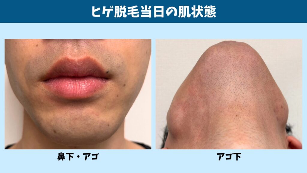 Skin condition immediately after beard hair removal treatment
