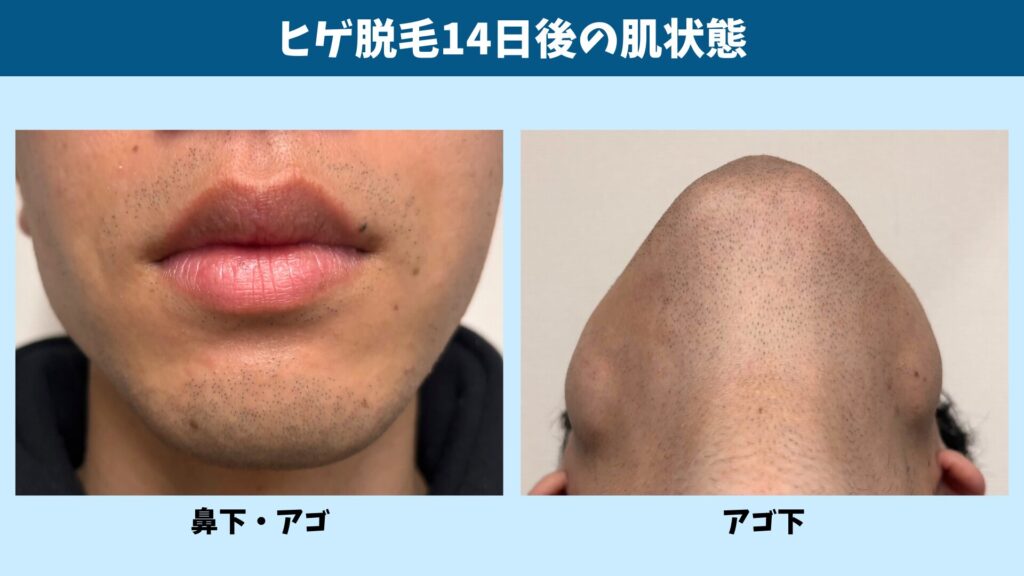 Skin condition 14 days after beard hair removal treatment