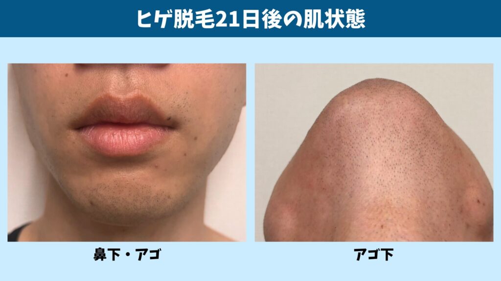 Skin condition 21 days after beard hair removal treatment