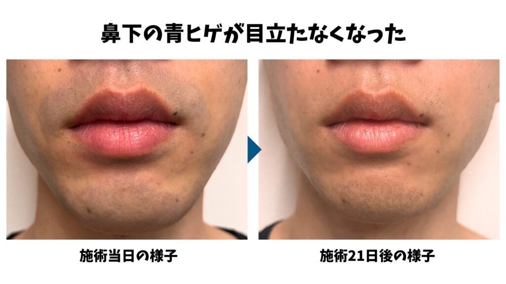 Comparison between the day of beard hair removal treatment and 21 days later