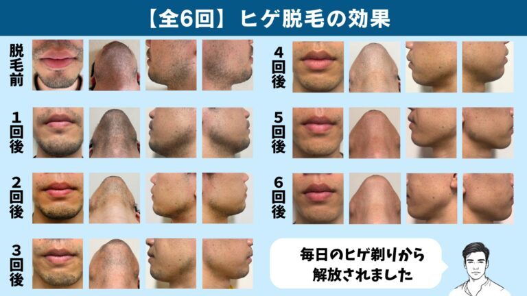 Effectiveness of beard hair removal by number of sessions at Shonan Beauty Clinic