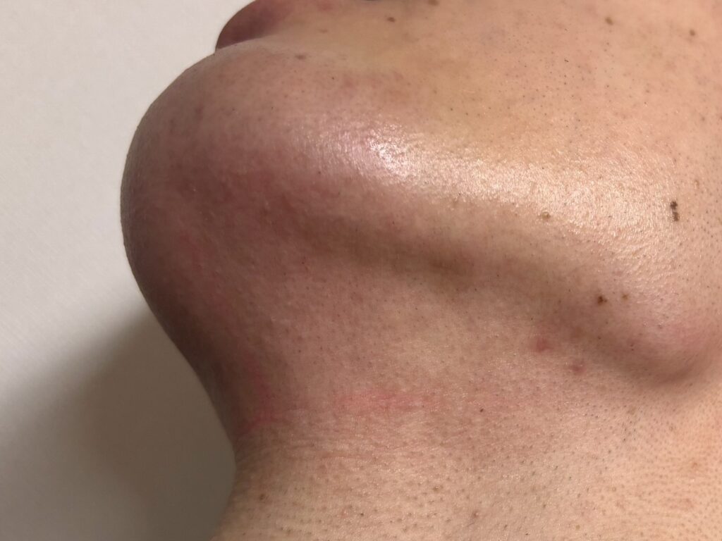 ヒゲ脱毛の照射後にアゴ先へ赤みが出た様子