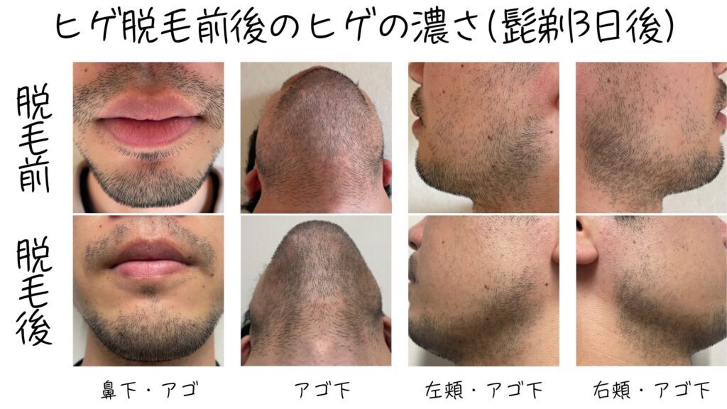 Results of the first beard hair removal session at Shonan Beauty Clinic