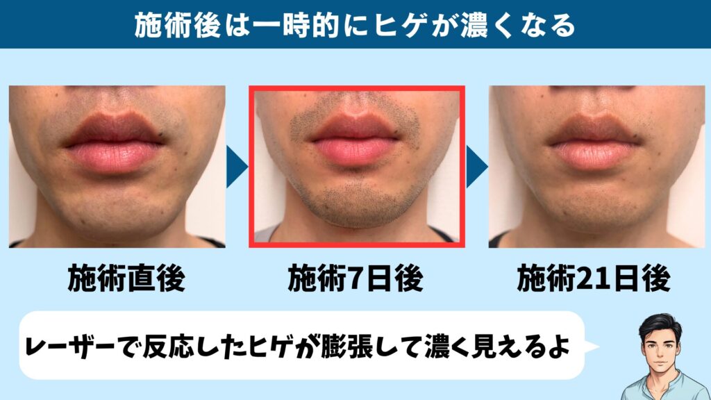 ヒゲ脱毛の施術後は一時的にヒゲが濃く見える