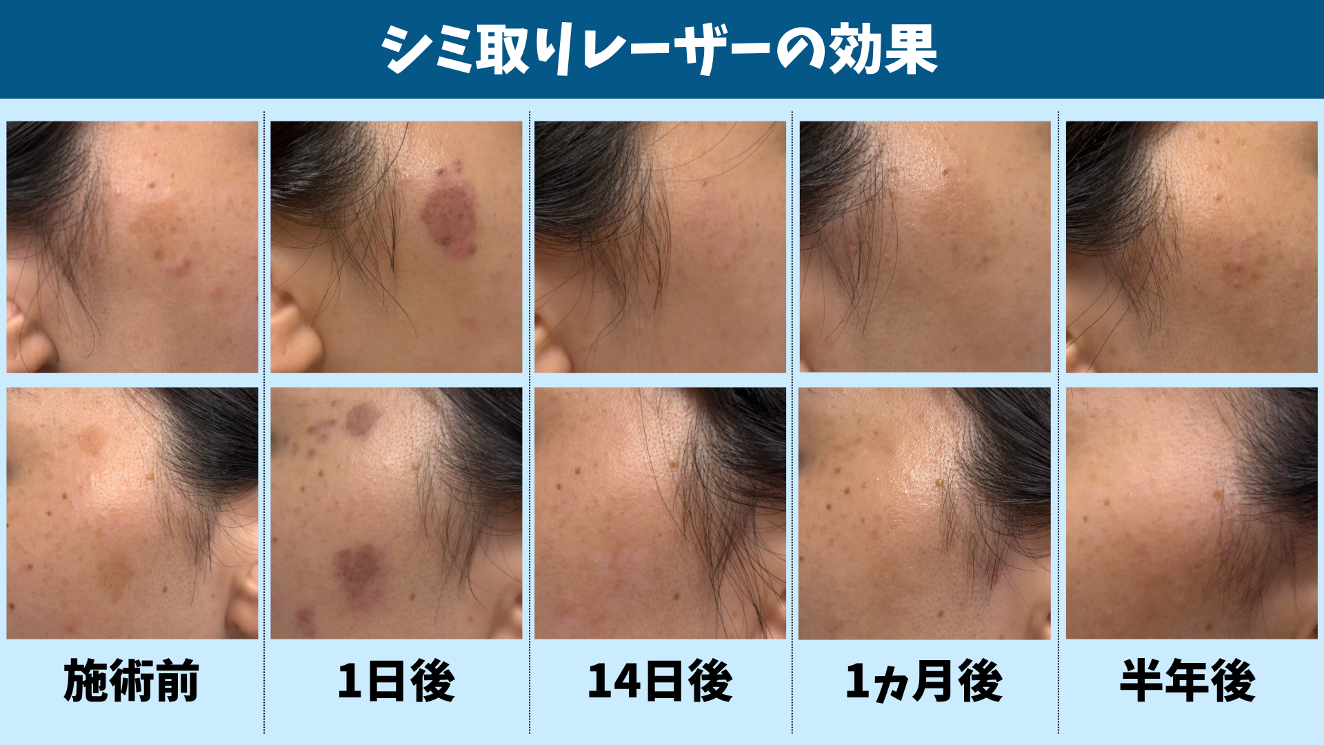 湘南 美容 外科 シミ 取り 失敗