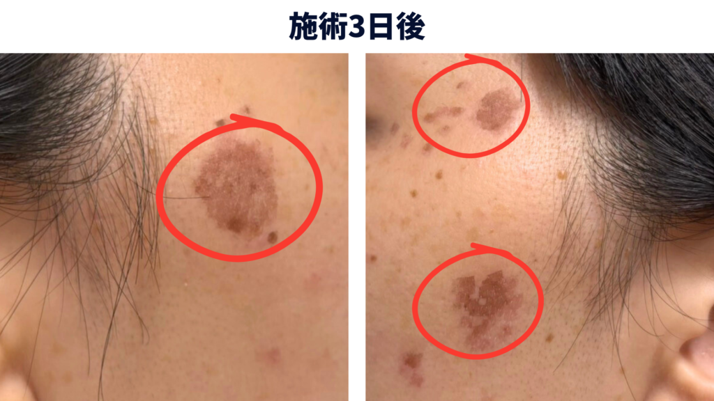 シミ取りレーザーから3日後、薄いかさぶたができた経過写真
