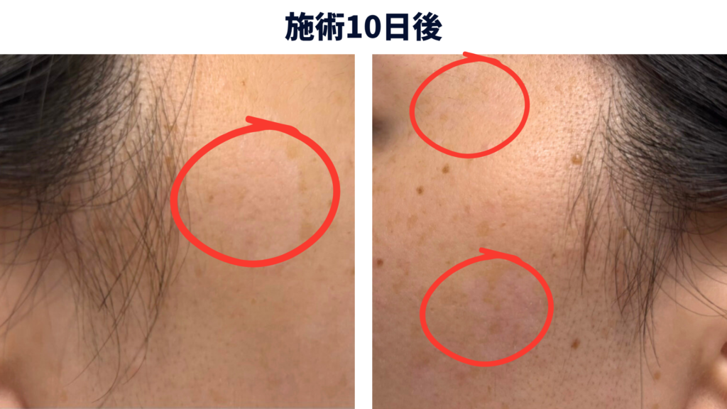 シミ取りレーザーから10日後、肌の色がなじみ始めた経過写真