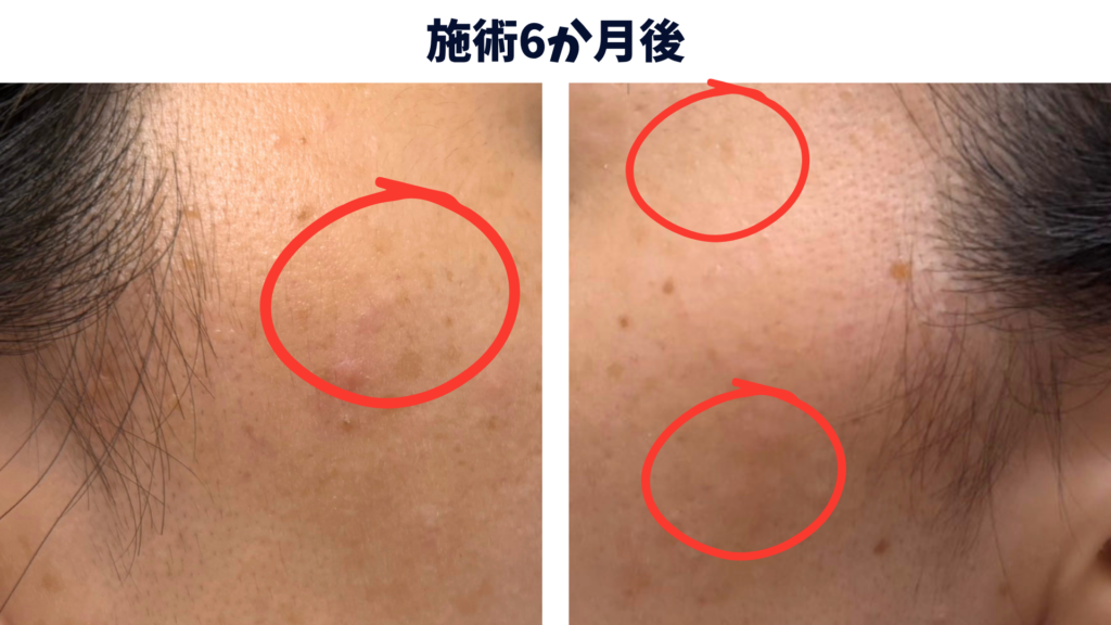シミ取りレーザーから半年後、シミがかなり薄くなった経過写真
