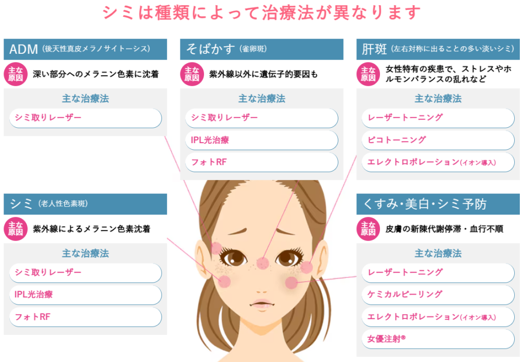 ADM・そばかす・肝斑・老人性色素斑などシミの種類ごとに治療法が異なることを示した図