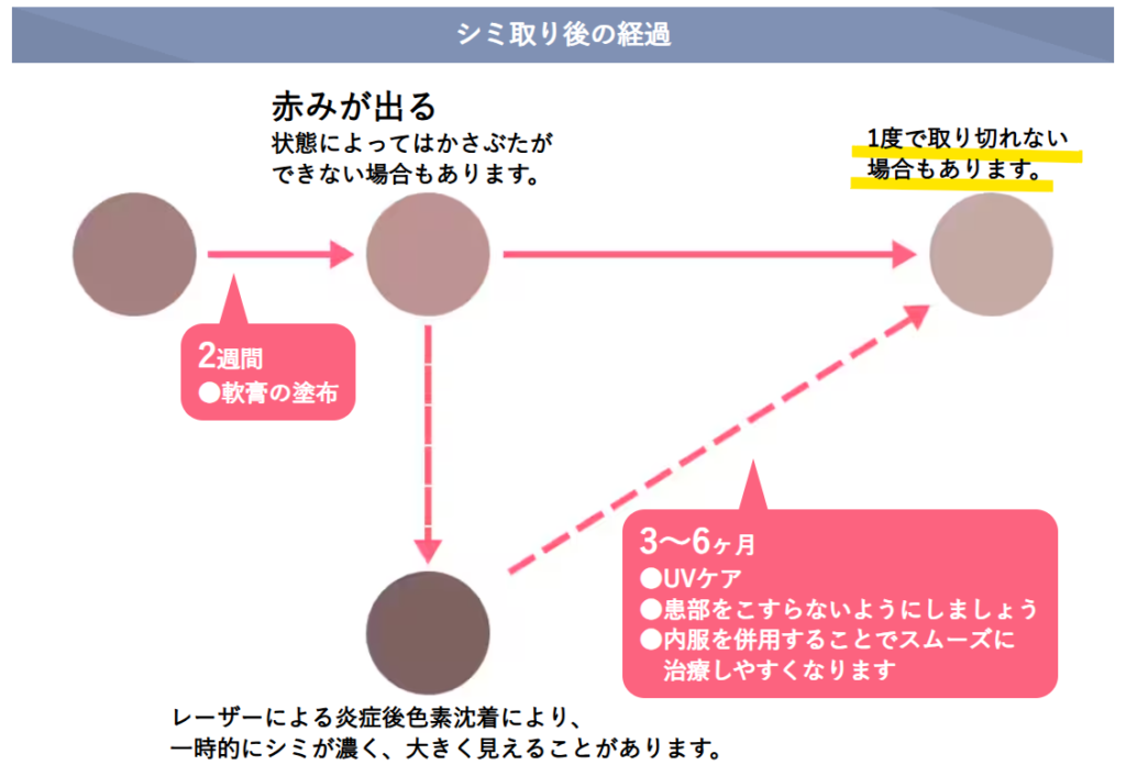 シミ取り後の経過と、1度で取り切れない場合があることを示した図