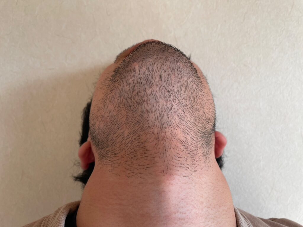 首まで生えていた筆者のヒゲの状態