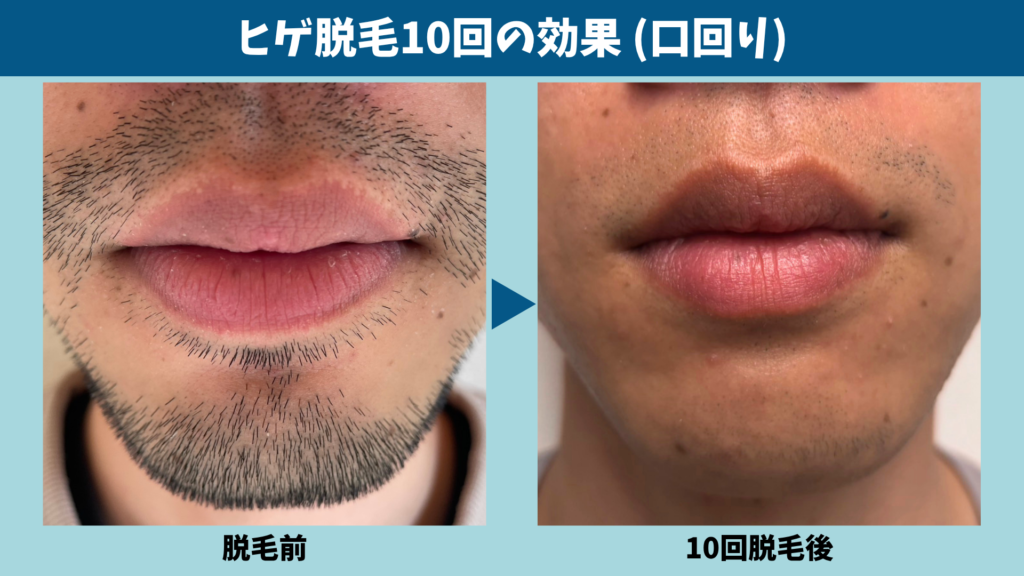 ヒゲ脱毛の施術前と10回終了後の口周りを並べた比較写真