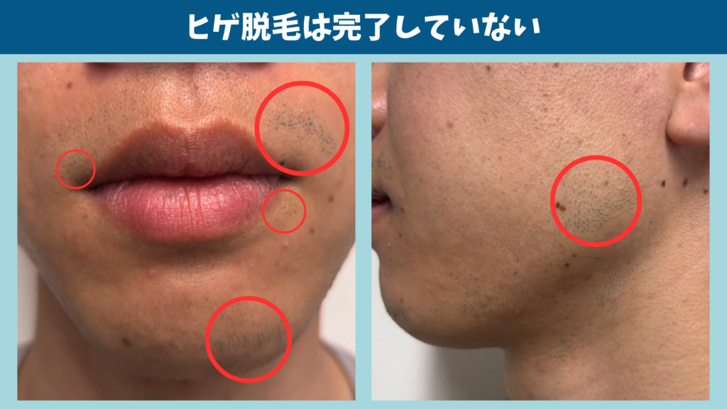 ヒゲ脱毛を10回終えても左側の鼻下やアゴに毛が残っている様子