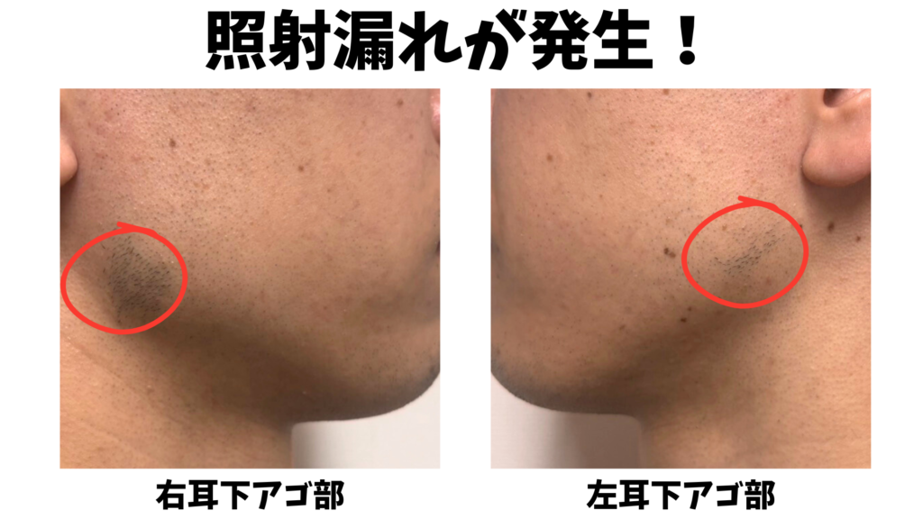 湘南美容クリニックで照射漏れが起きた箇所を示した図解