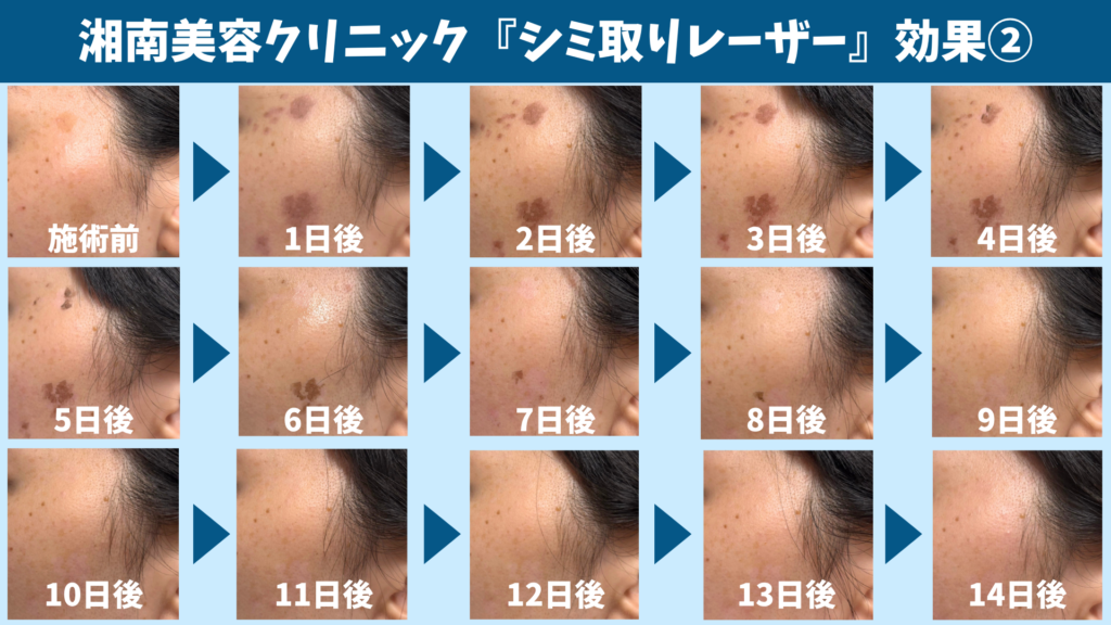 シミ取りレーザー施術後にシミが薄くなった状態を写した画像