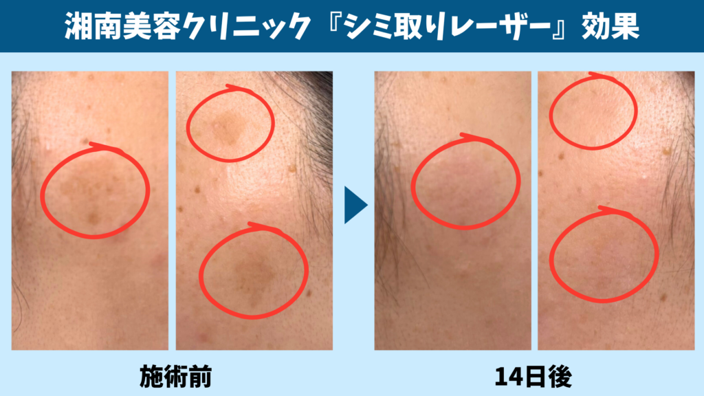 シミ取りレーザーの施術前と14日後のシミを比較した画像